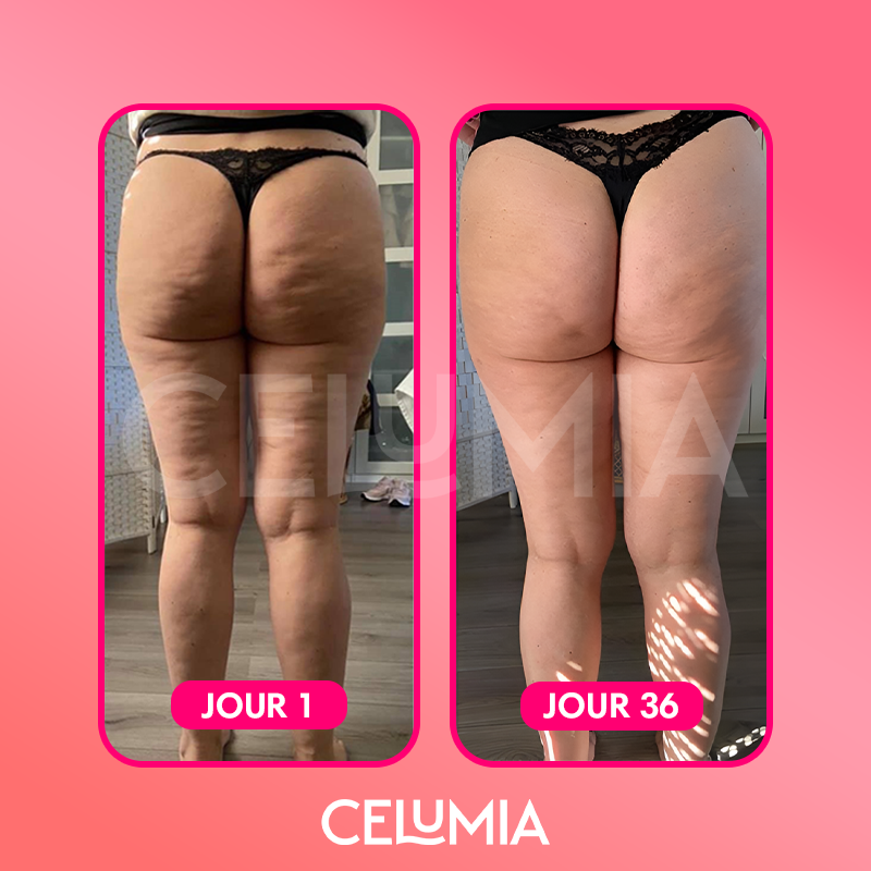 Kit Masseur Anti-Cellulite - Celumia™