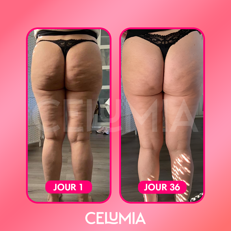 Kit Masseur Anti-Cellulite - Celumia™