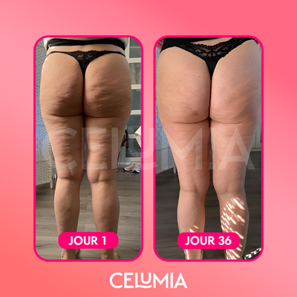 Kit Masseur Anti-Cellulite - Celumia™